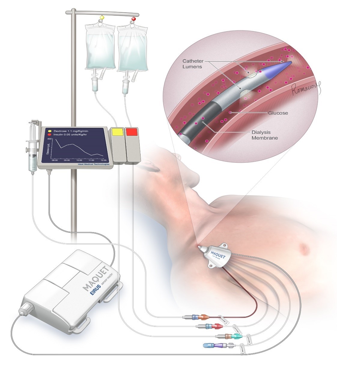 Artificial Pancreas to lower ICU mortality rates