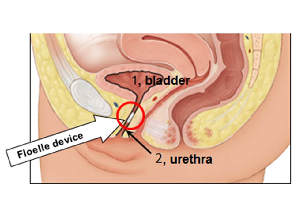 Treating female stress urinary incontinence